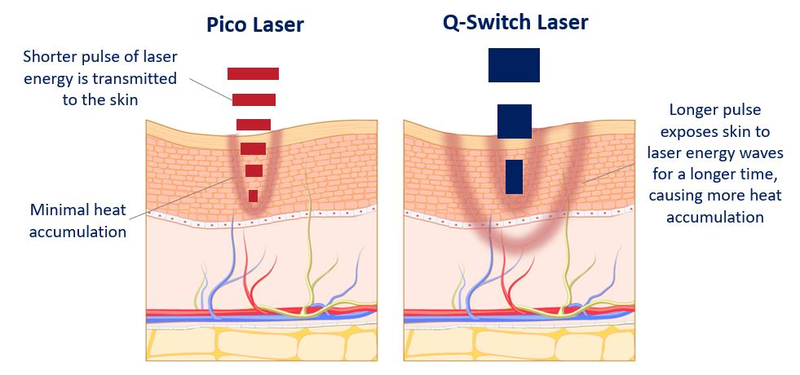 vs Qswitch vs Qswitch