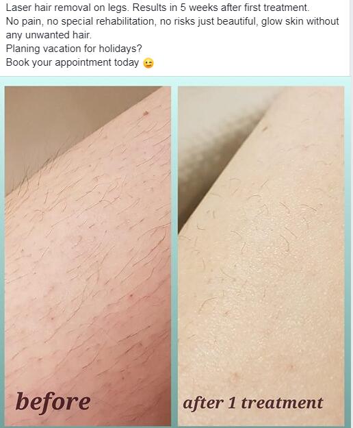 ipl hair removal reviews ipl hair removal reviews