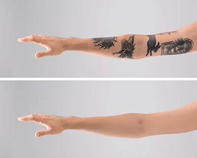 laser tattoo removal laser tattoo removal
