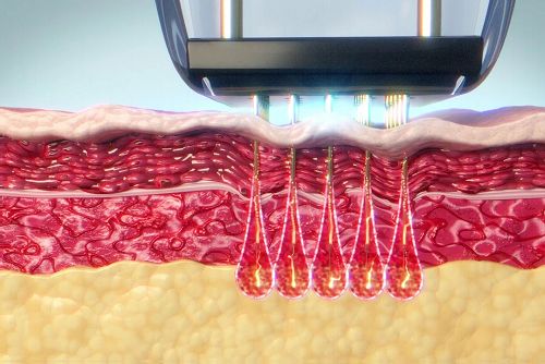 The Ultimate Guide To Microneedle RF For Skin Texture