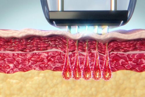 OEM RF Microneedling Machines: A Guide For Beauty Equipment Distributors