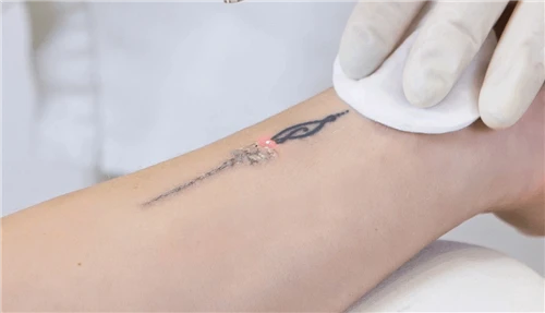 How Much Does Q-switched Laser Tattoo Removal Equipment Cost?