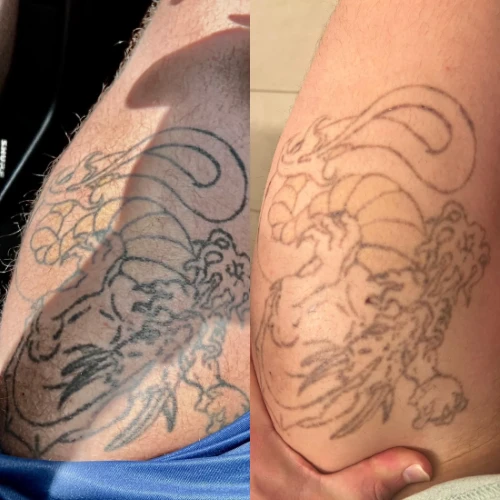 Pico Laser Before And After: Results, Science, And Recovery