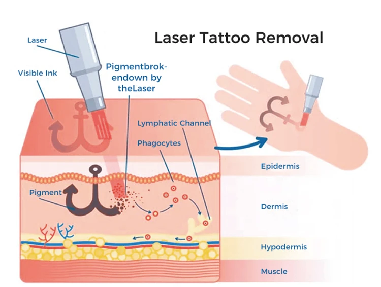 Laser tattoo removal principles Laser tattoo removal principles
