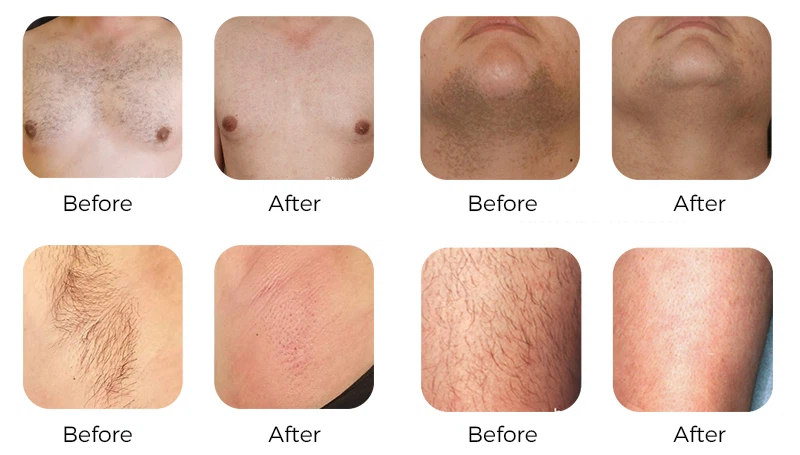 Application of Our Alexandrite Laser Hair Removal Application of Our Alexandrite Laser Hair Removal